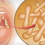 Diphtheria 1