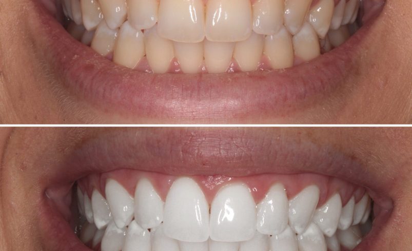 10 Foods to Avoid to Maintain White Teeth