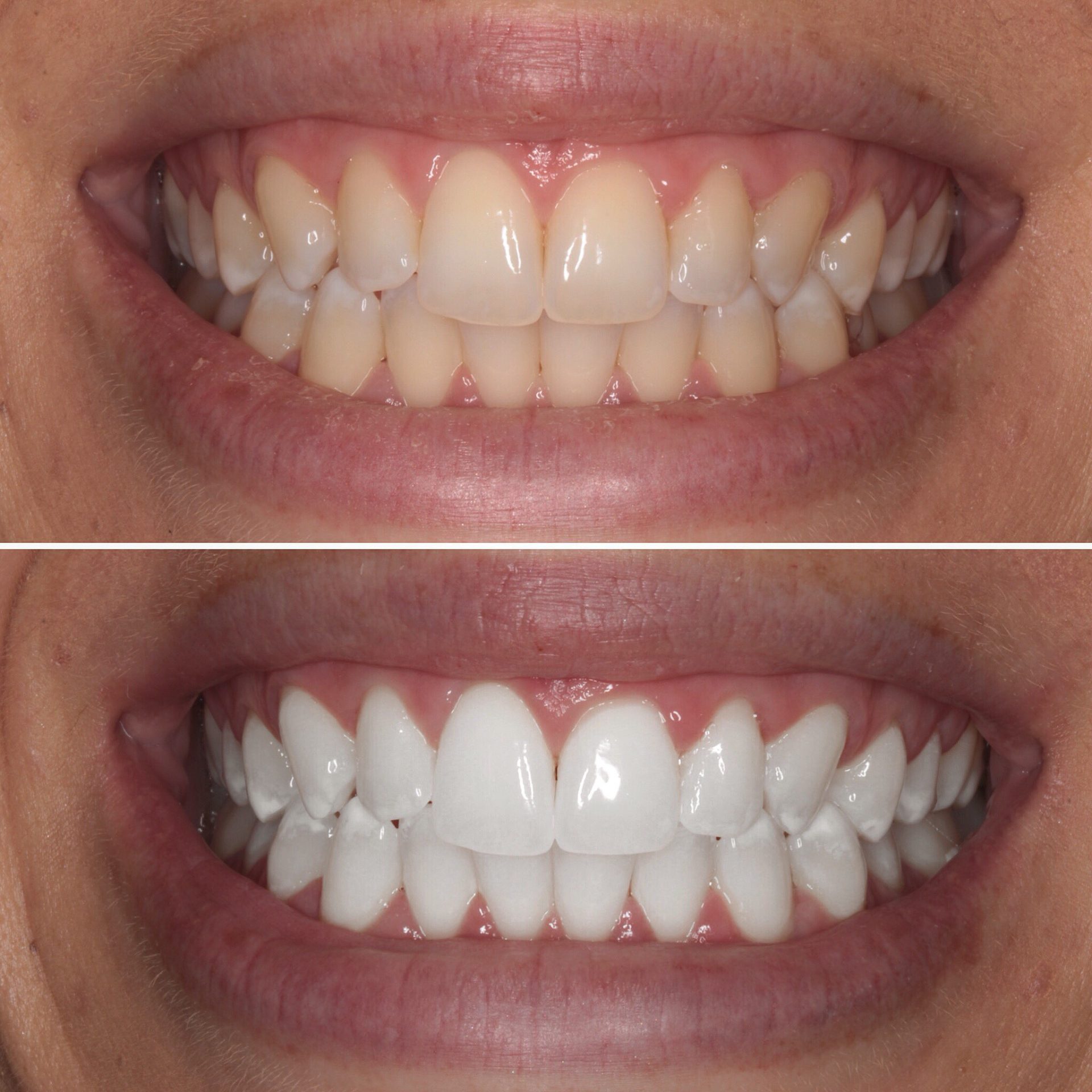 10 Foods to Avoid to Maintain White Teeth