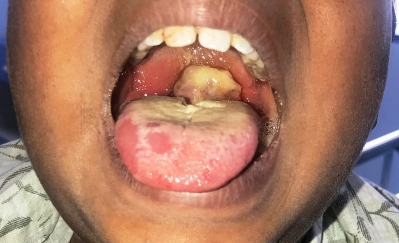 Diphtheria Outbreak in Nigeria: Rising Death Toll Sparks Fresh Warning to Residents